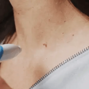 Skin Tag Removal Kit - Effortlessly Eliminate Skin Tags