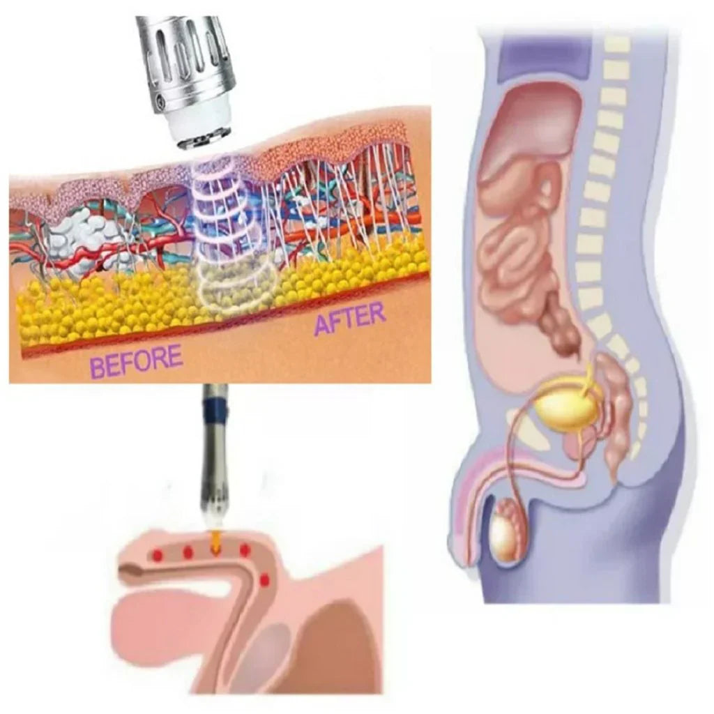 Portable ED Shockwave Therapy Device for Men