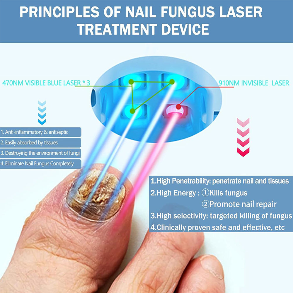 At-Home Laser Device for Toenail Fungus Treatment