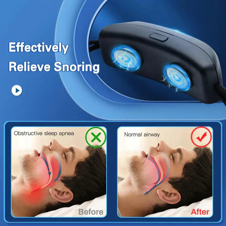 Portable Smart Anti-Snoring Device with EMS Pulse for Comfortable Sleep and Sleep Apnea Relief - USB Rechargeable